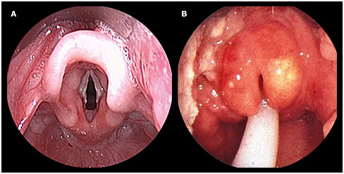 Acute epiglottitis